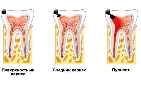 Виды пульпита молочных зубов