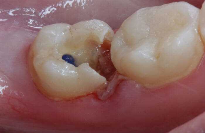 Специалисты «Диал-Дент», выполнившие лечение пульпита зуба мудрости