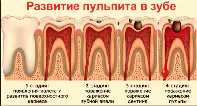 Лечение каналов зуба мудрости с микроскопом