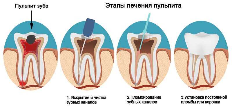 Инновационные методы лечения пульпита зуба мудрости, избежавшие рутинной хирургической интервенции и обеспечившие сохранение зуба!