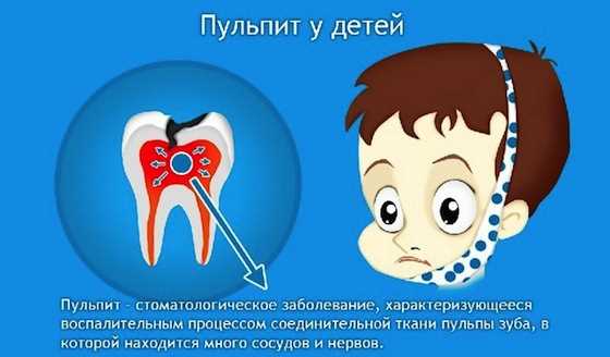 Лечение пульпитов временных зубов