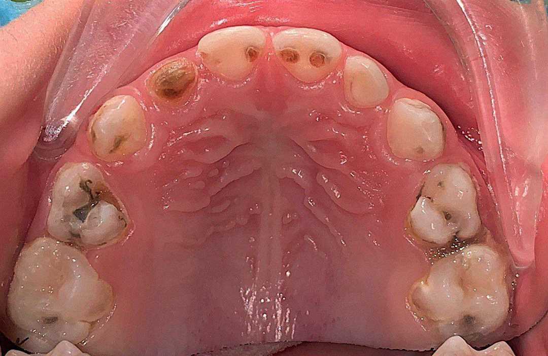 Разрушение зубов как последствие кариеса у детей в раннем возрасте