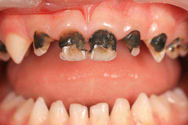 Почему у детей появляется кариес на зубах?