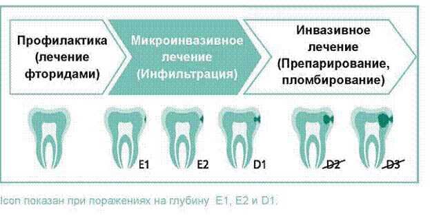 Преимущества лечения кариеса в нашей стоматологии