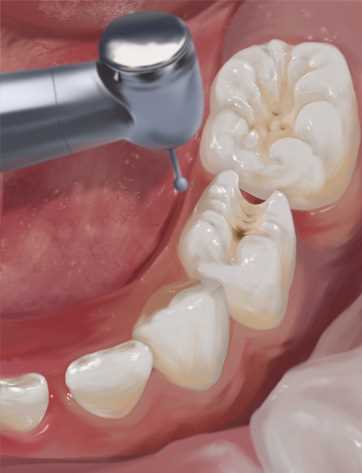 Возможные последствия среднего кариеса зубов