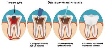 Цена лечения пульпита 3-канального зуба в клинике Ортодонт Сити