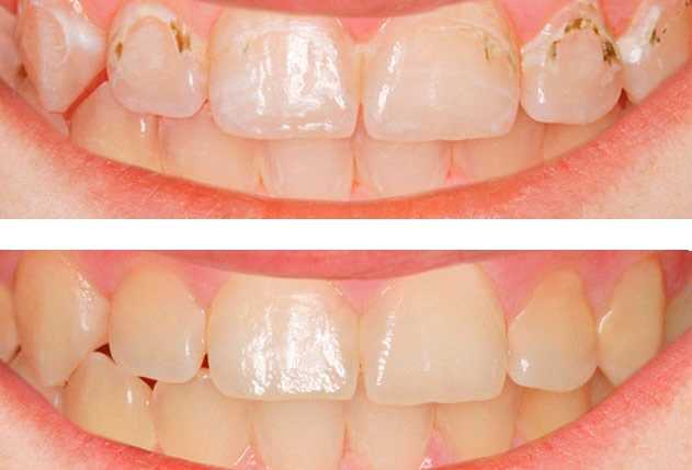 Как избежать повторного появления кариеса и сохранить здоровье зубов надолго