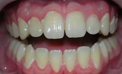 Лечение зуба около десны