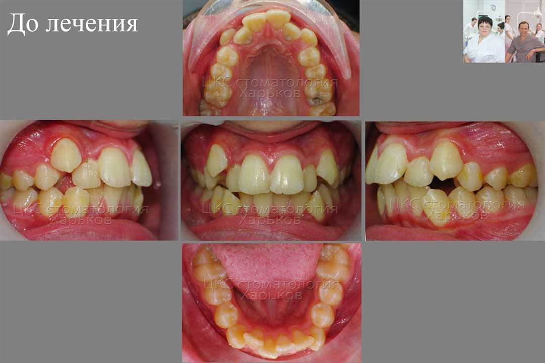 Преимущества лечения кариеса в нашей стоматологии