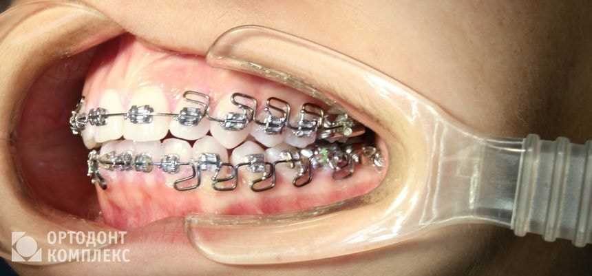 Лечение зубов без удаления