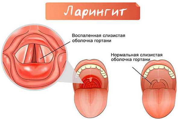 Лимфоузлы после удаления зуба