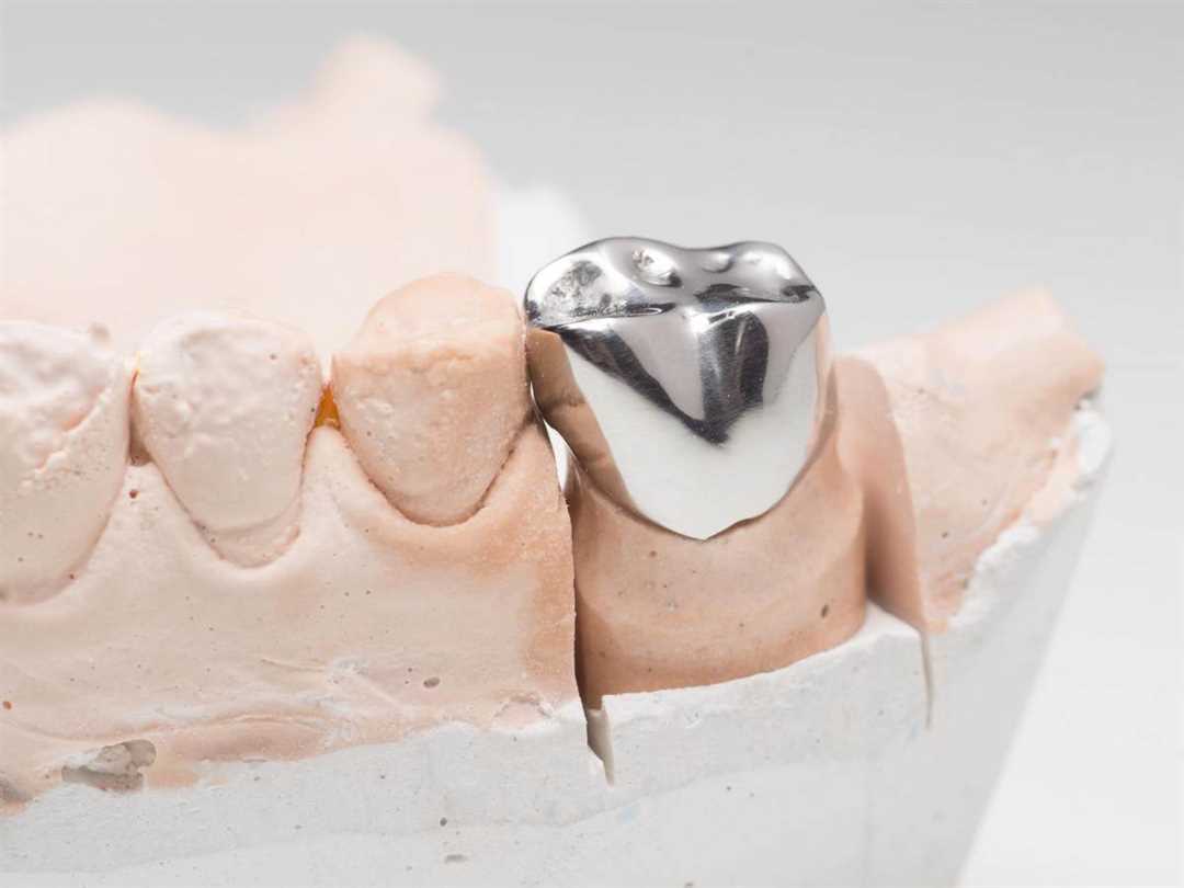 Преимущества и особенности применения литых зубных коронок для красивой и здоровой улыбки