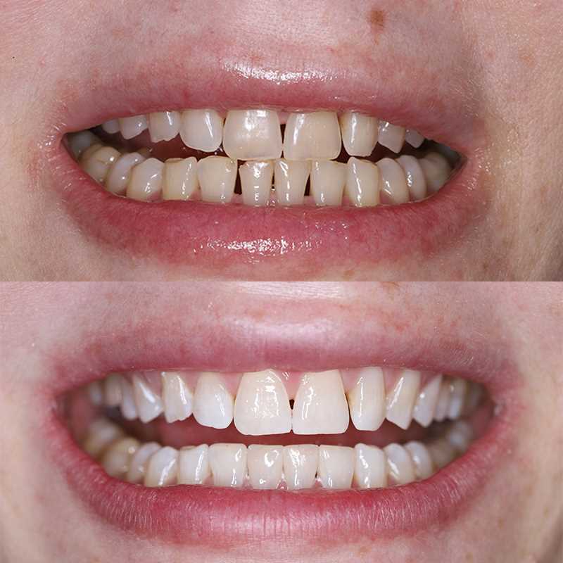 Лучшая реставрация зубов