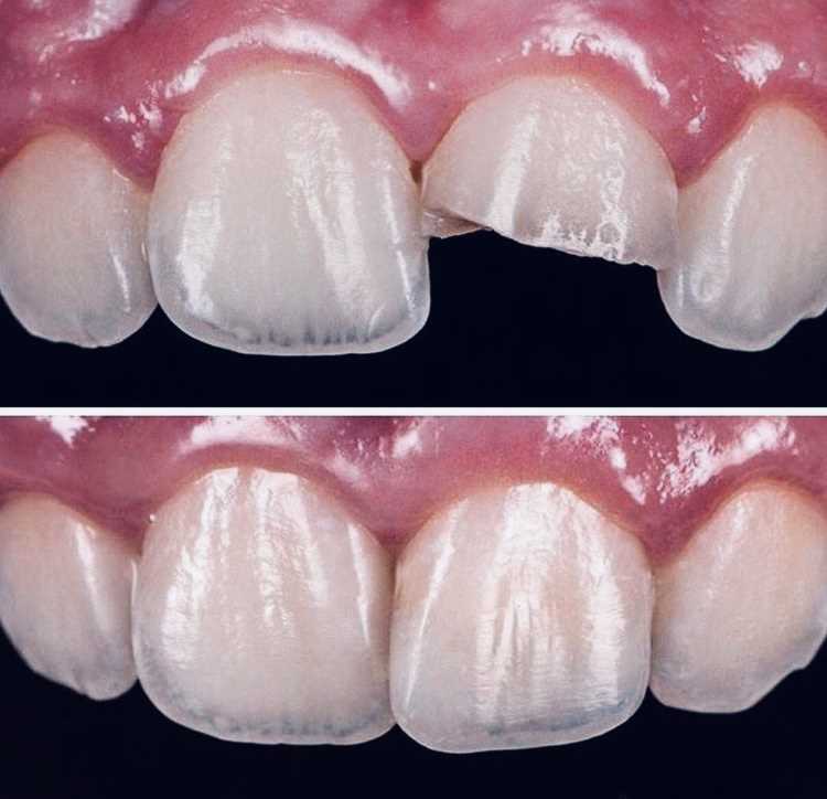 Как проходит художественная реставрация зубов