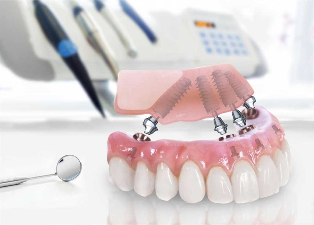 Лучшее протезирование зубов