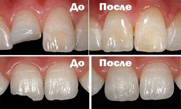 Какие бывают материалы для реставрации зубов?