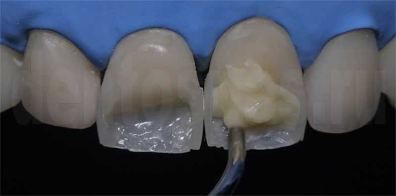 Прямая композитная реставрация фронтальных зубов