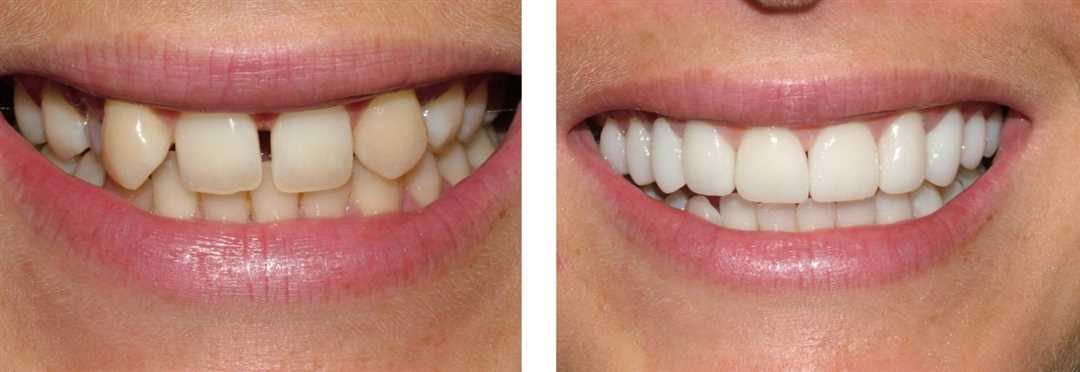 Материалы для реставрации фронтальных зубов