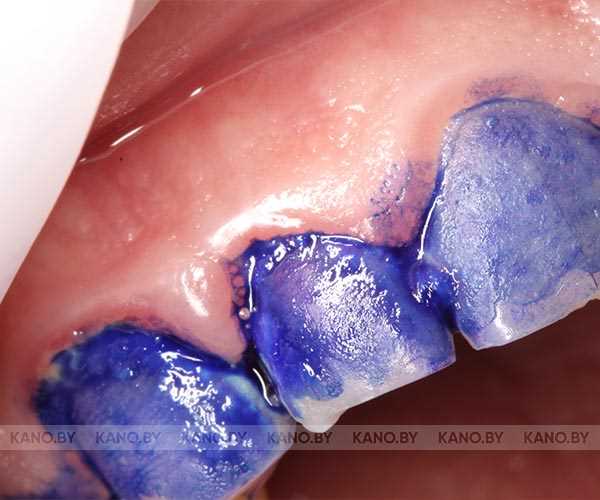 Процесс мазка зубного налета окраска по граму