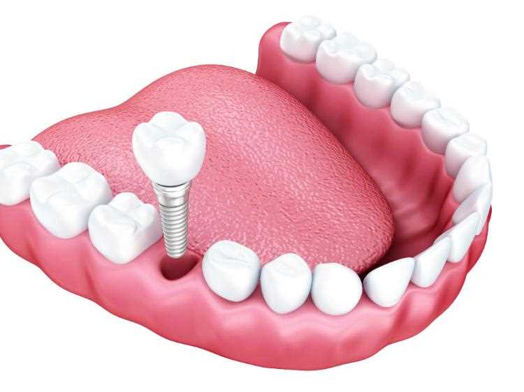 Медицина протезирование зубов — как вернуть мощный укус и улыбку без стоматологической патологии