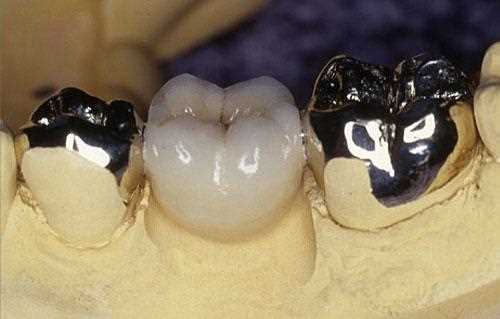 Металлические зубные коронки — крепкие, надежные и долговечные реставрации зубов