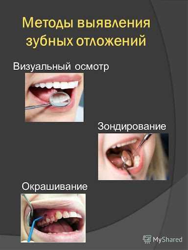 Методы выявления зубных отложений: