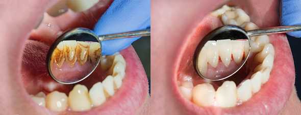 Механическая чистка зубов – с дополнительным уходом