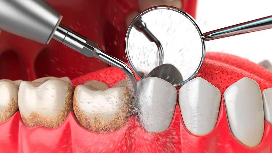 Механическое удаление зубного камня