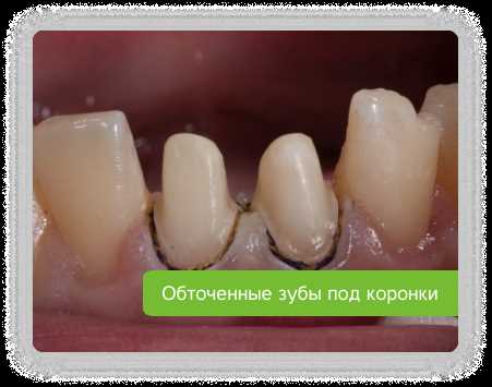 Неплотный контакт между зубами ошибки лечения.