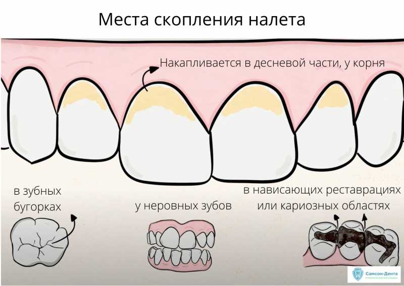 Что ты - камень зубной?