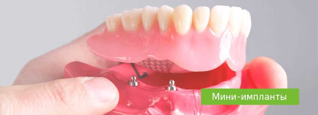 Что такое мини-импланты зубов?