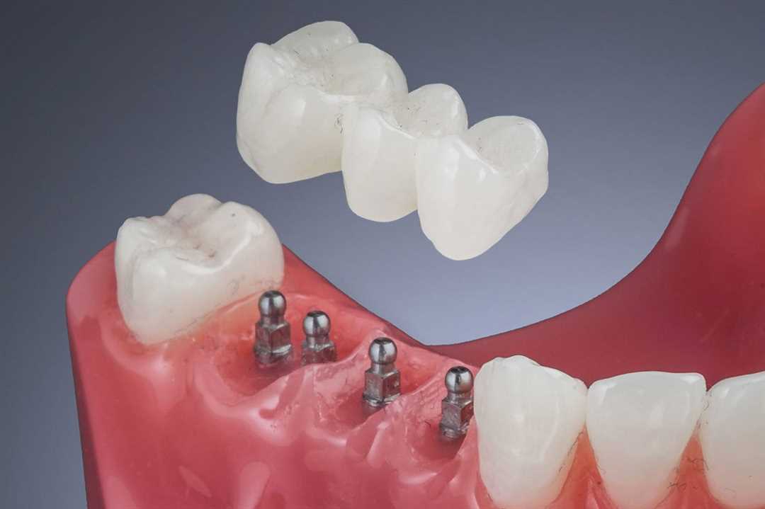 Мини протезирование зубов
