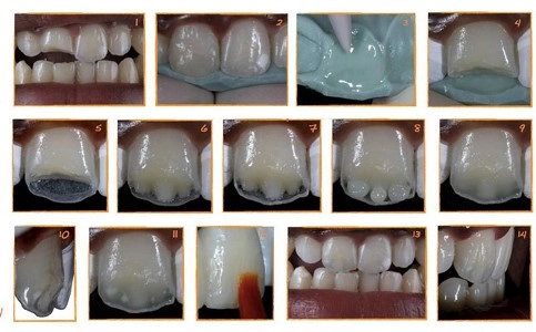 Прямая реставрация зубов и ее особенности