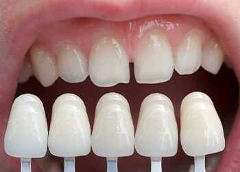 Минусы реставрации зубов