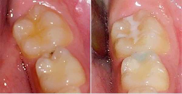 Множественный кариес — как справиться с несколькими поражениями зубов?