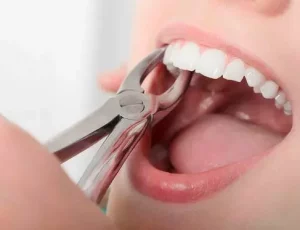 Как помочь молочному зубу выпасть самостоятельно?