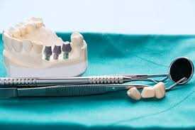 Каким цементом зафиксировать зубные коронки — выбор материала для надежной фиксации