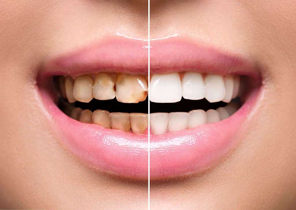 Что не следует делать после реставрации зубов