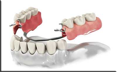 Необходимость протезирования при частичной или полной утрате зубов.