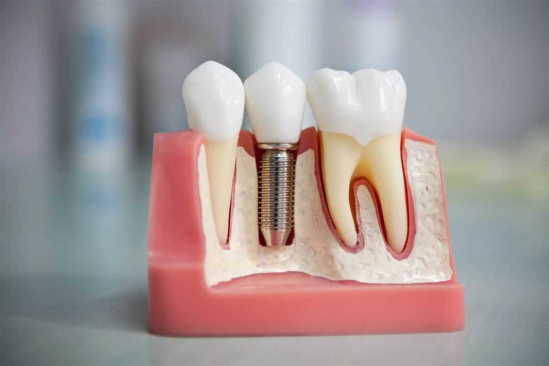 Необходимость протезирования зубов