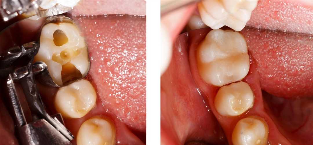 Неправильное лечение пульпита 36 зуба
