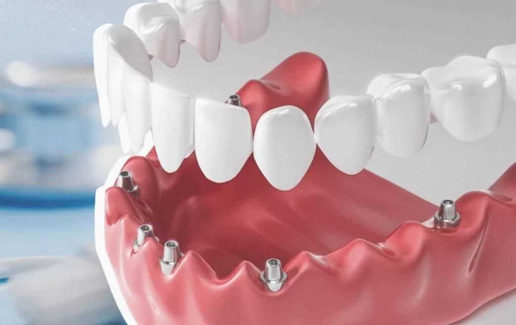 Неправильное протезирование зубов — последствия и способы их устранения