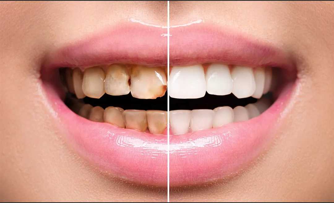 Какими методами реставрируют зубы в стоматологической поликлинике?