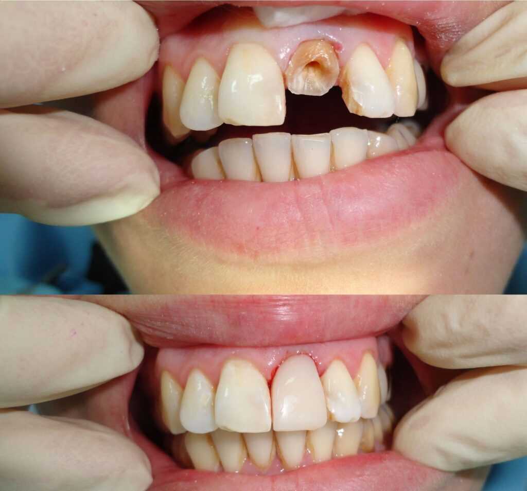 4. Осторожность при использовании зубной нити
