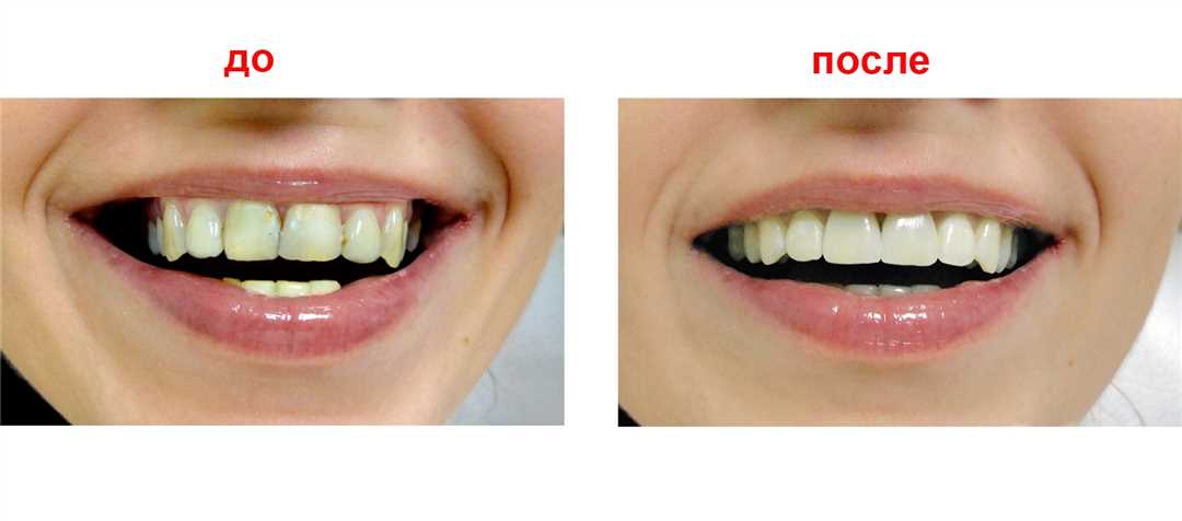 Непрямая реставрация зубов
