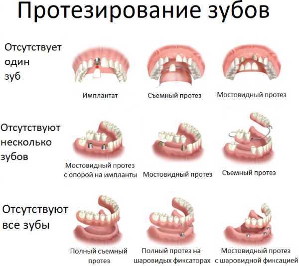 Причины протезирования зубов