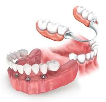 Областная стоматология протезирование зубов
