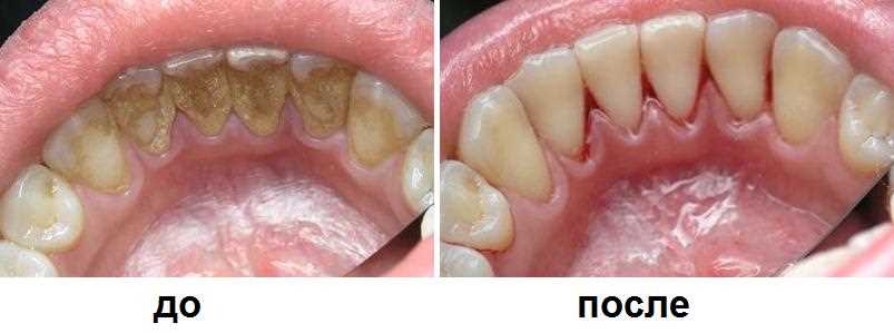 18. Особенности поддесневого зубного налета