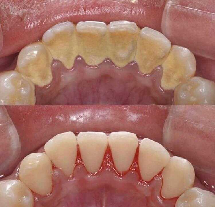 Образованию зубного налета способствует