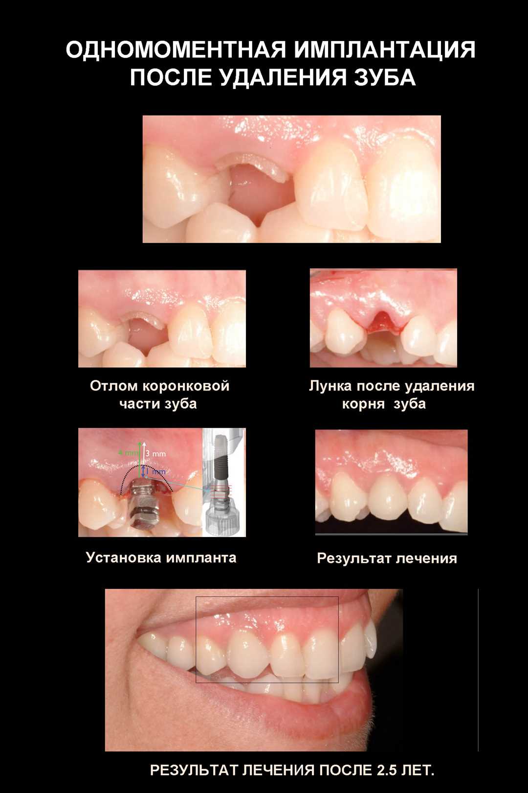 Одномоментное удаление зуба — безболезненная процедура современной стоматологии
